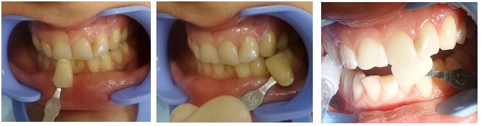 Фотографии ДО и ПОСЛЕ процедуры Spa Dent. С А3 на фронтальных зубах и А3.5 на клыках и премолярах - до А1 .